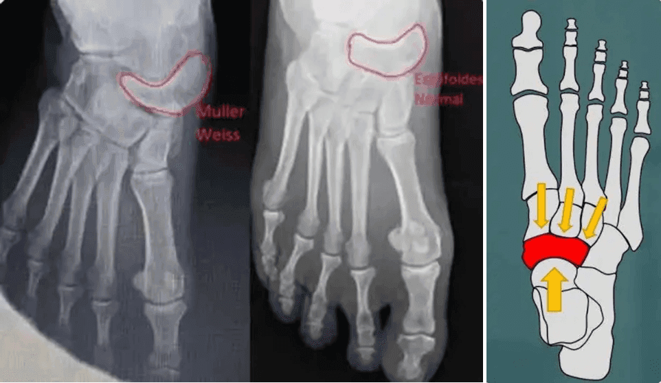 Síndrome de Muller-Weiss - Imágenes web Dr. Álvaro Iborra